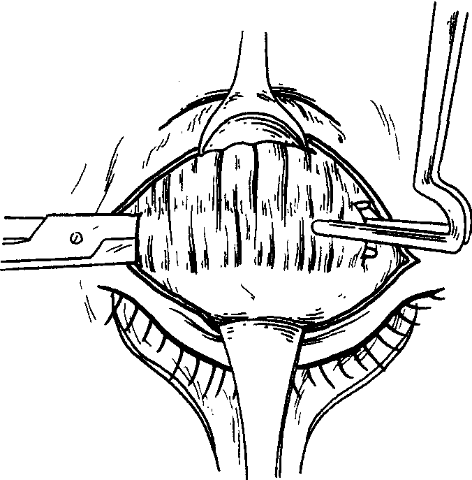 (1)Berke’s提上瞼肌縮短術(shù)