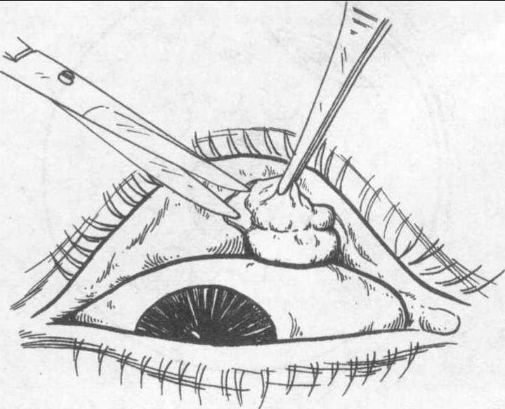 6 結(jié)膜囊腫切除術(shù)