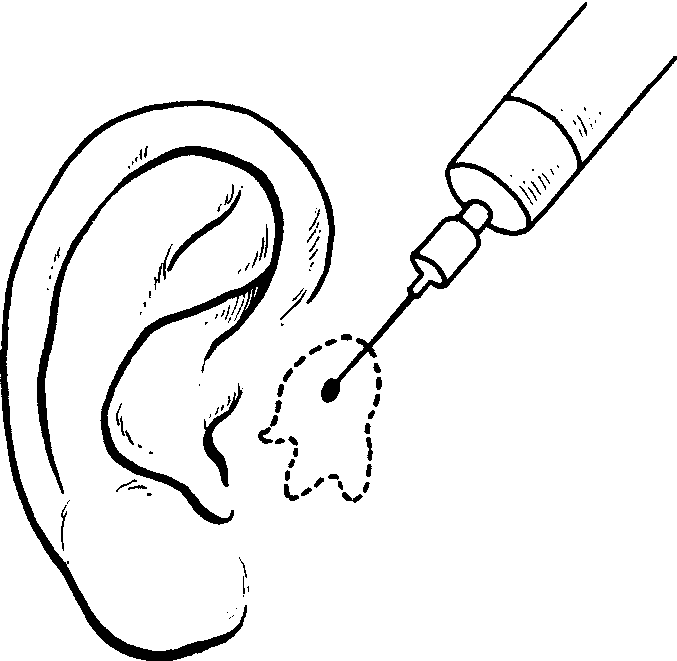 1 耳前瘘管摘除术