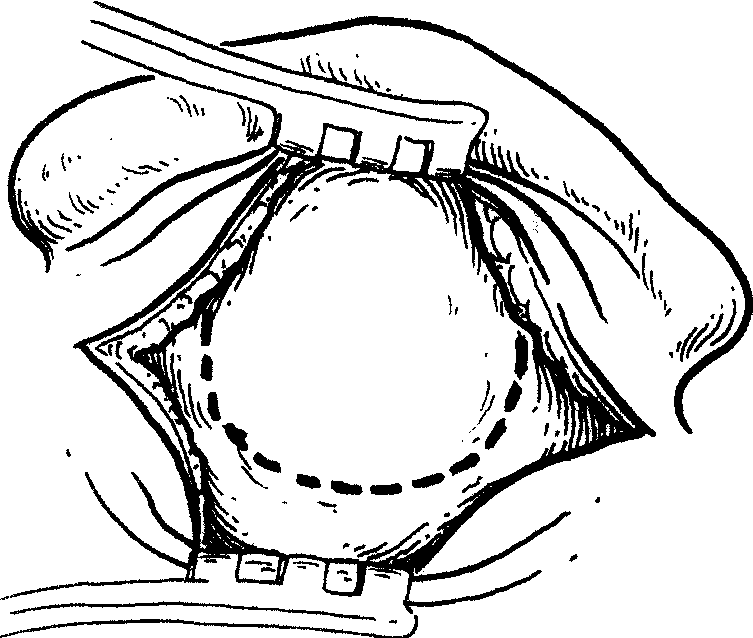 12 完壁式鼓室成形術(shù)
