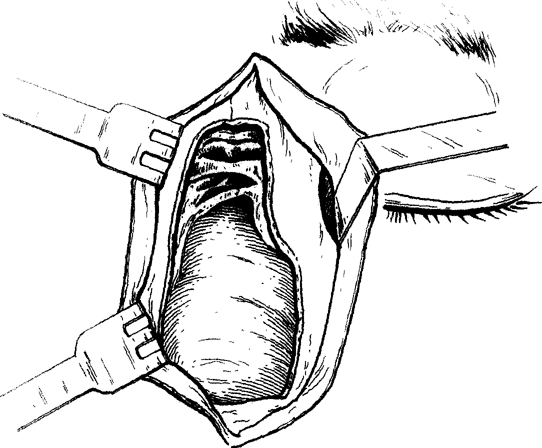17 鼻側切開術