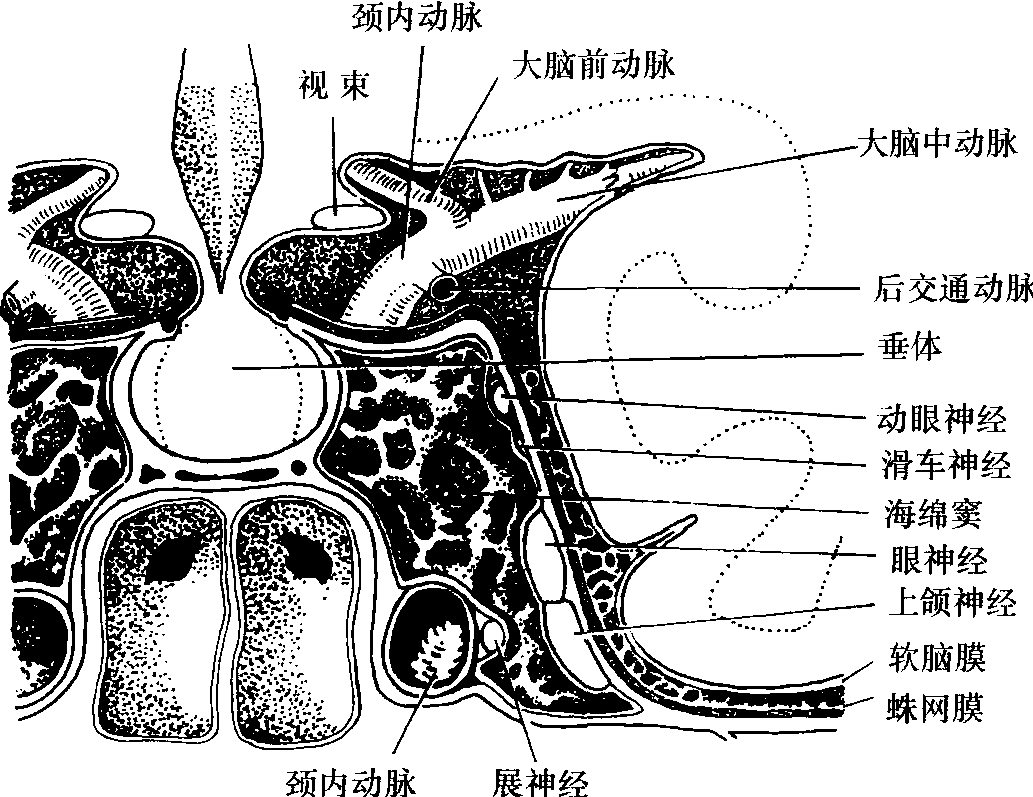 蝶鞍(冠狀面)
