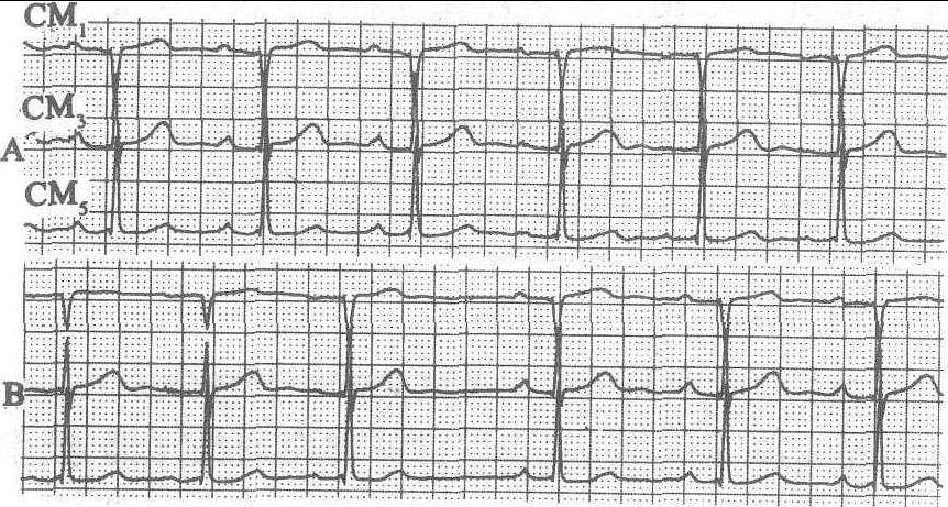 窦房结心电图特征图片