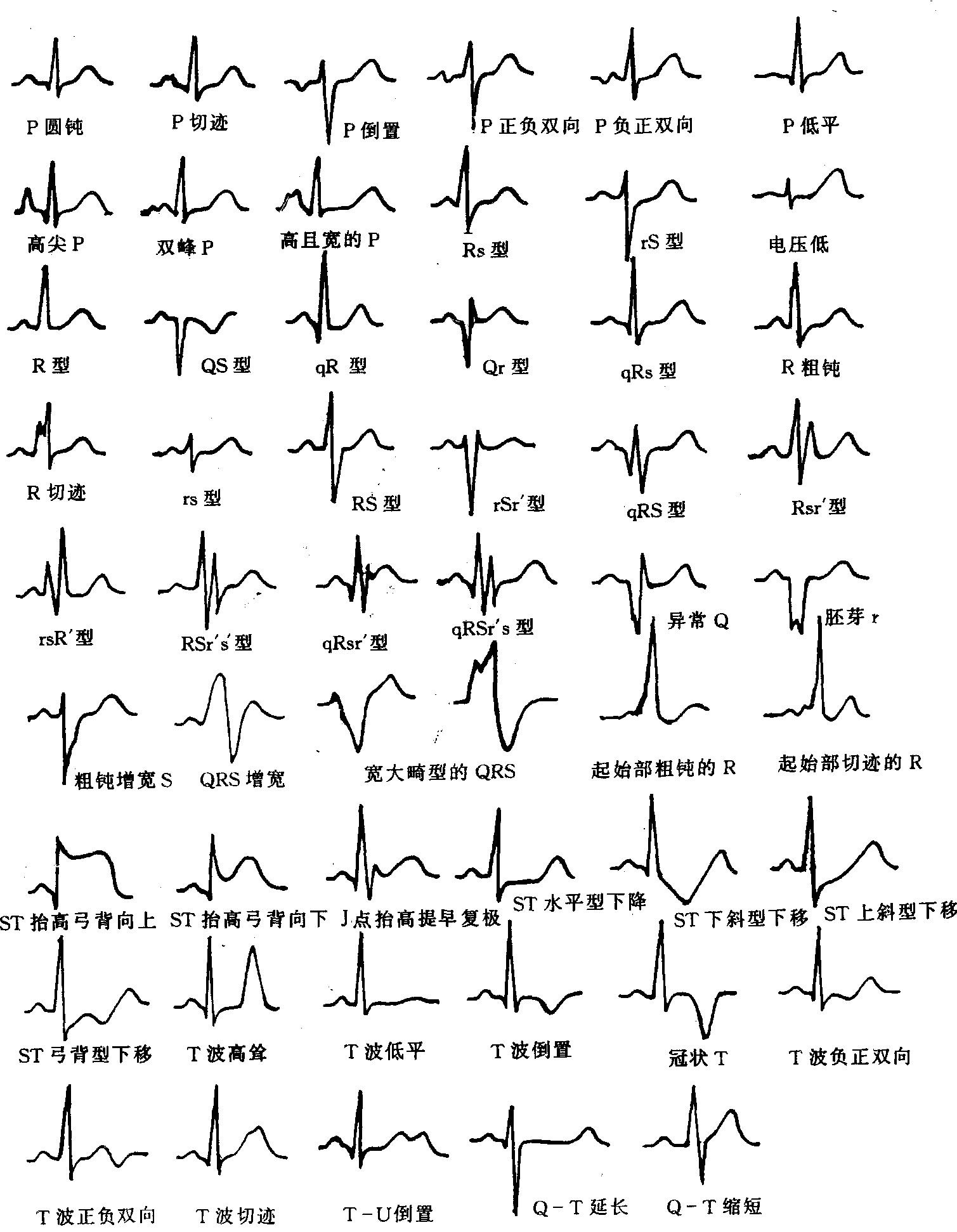 1-5 P、QRS、ST、T、U集中識(shí)圖(圖1-5)