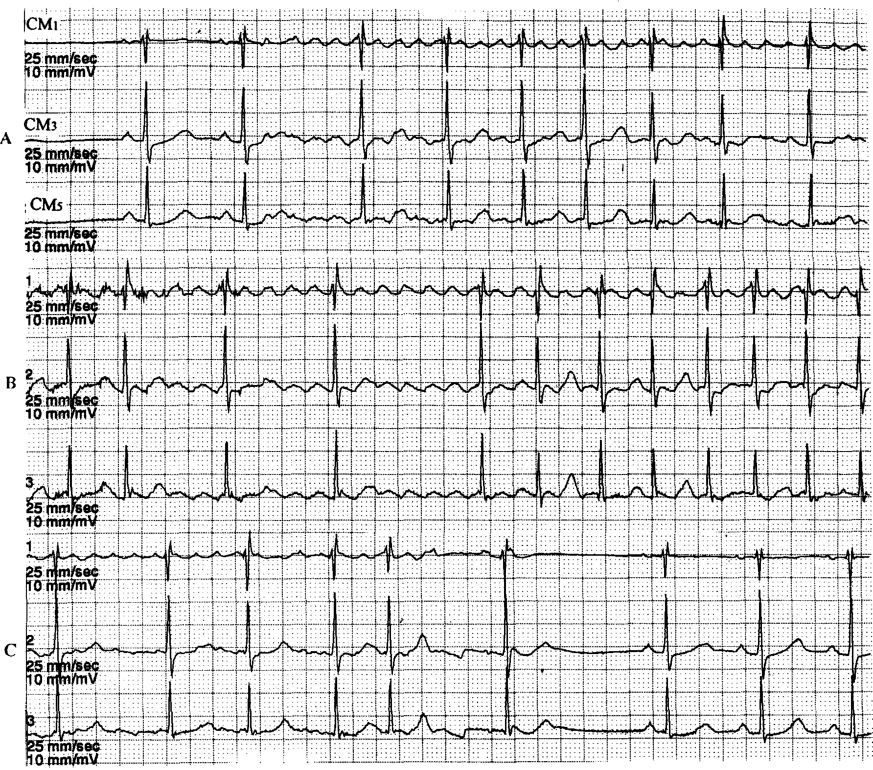 心电图上以规则的f波为主,其间夹杂有短暂的心房颤动的f波(图10