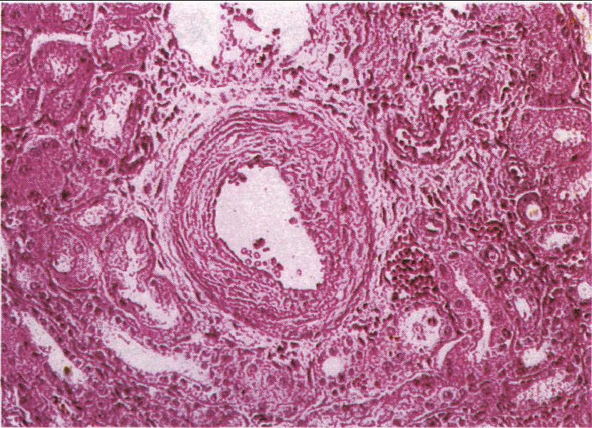 图1-24 肾间质动脉硬化