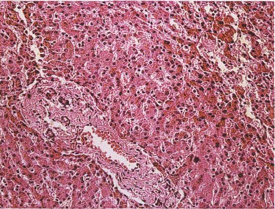 图9-65 肝细胞点状坏死
