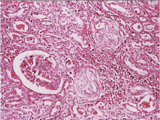 图11-19 弥漫性硬化性肾小球肾炎