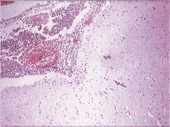 图14-17 化脓性脑膜炎