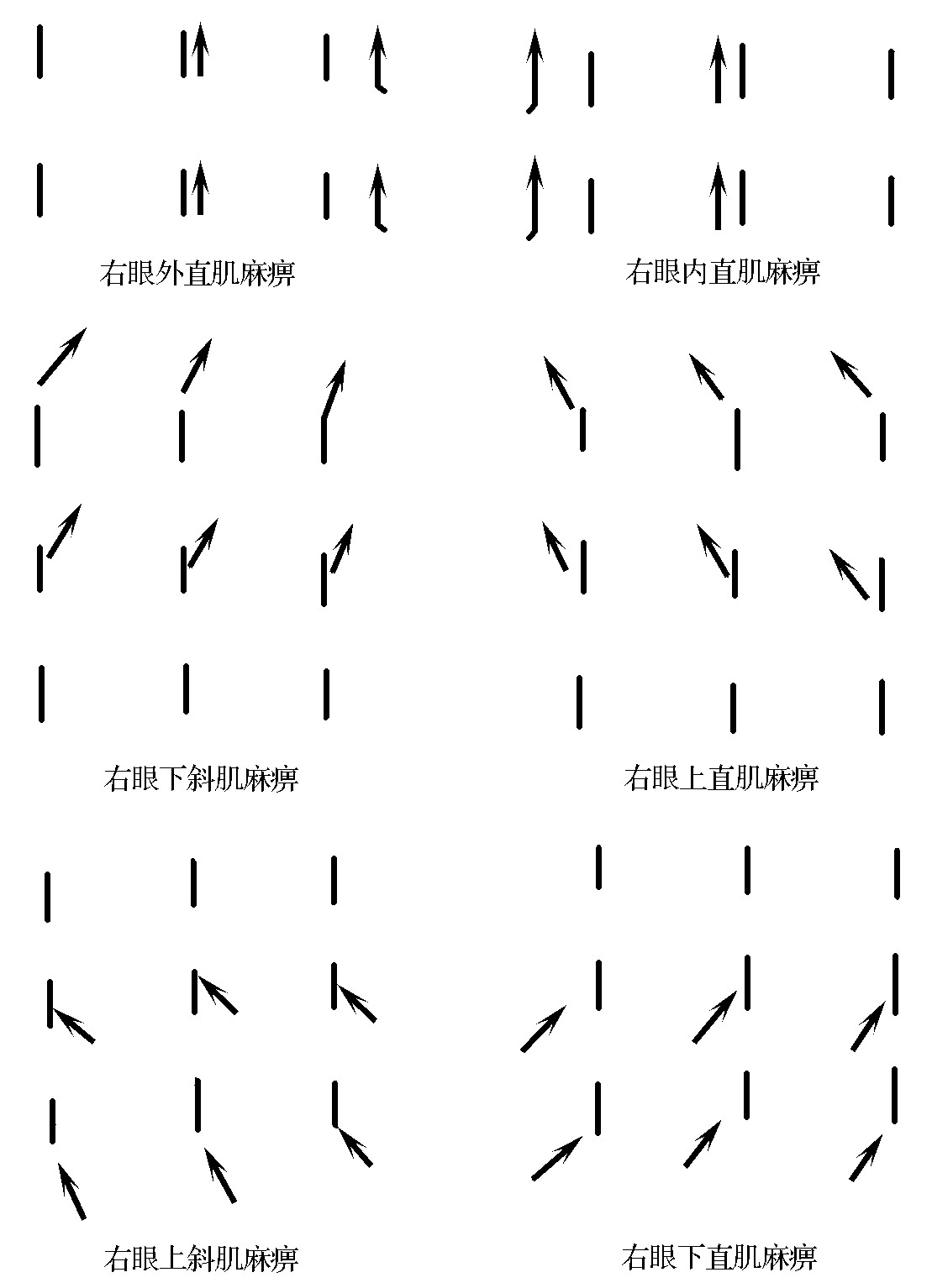 第二節(jié) 麻痹性斜視的癥狀及檢查法