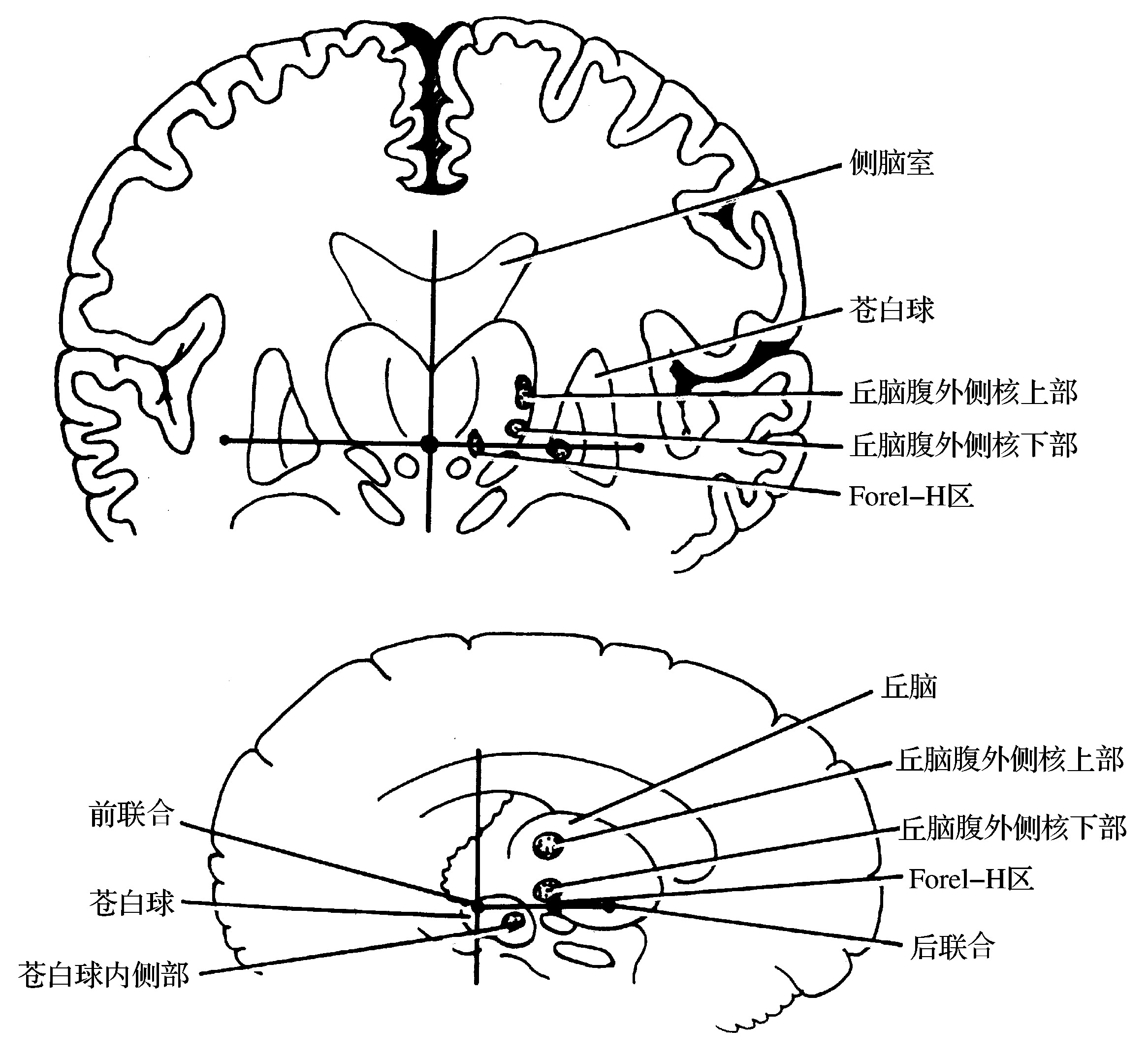 18.2　帕金森病苍白球内侧部毁损术