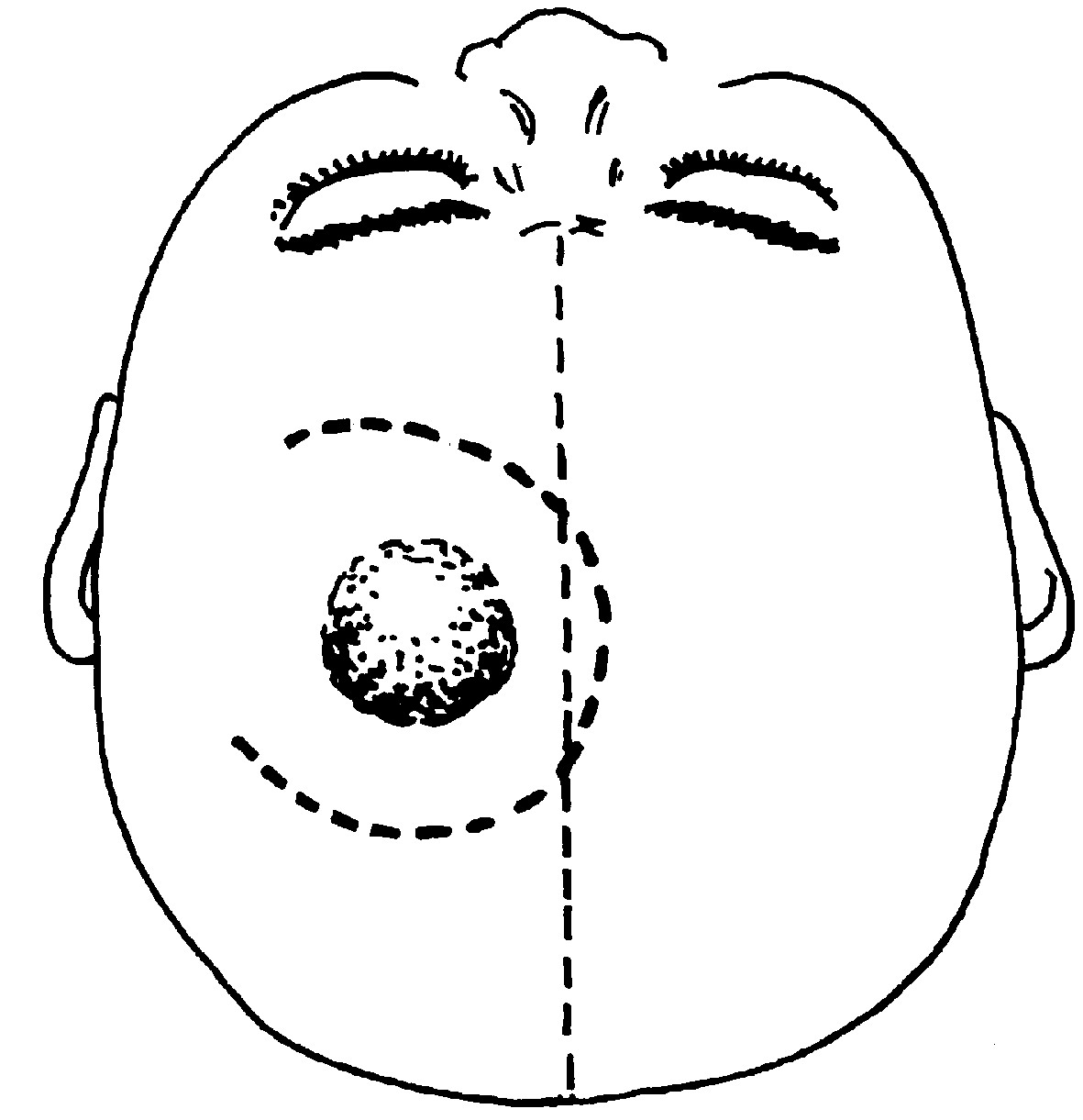 矢狀竇旁腦膜瘤切除術(shù)