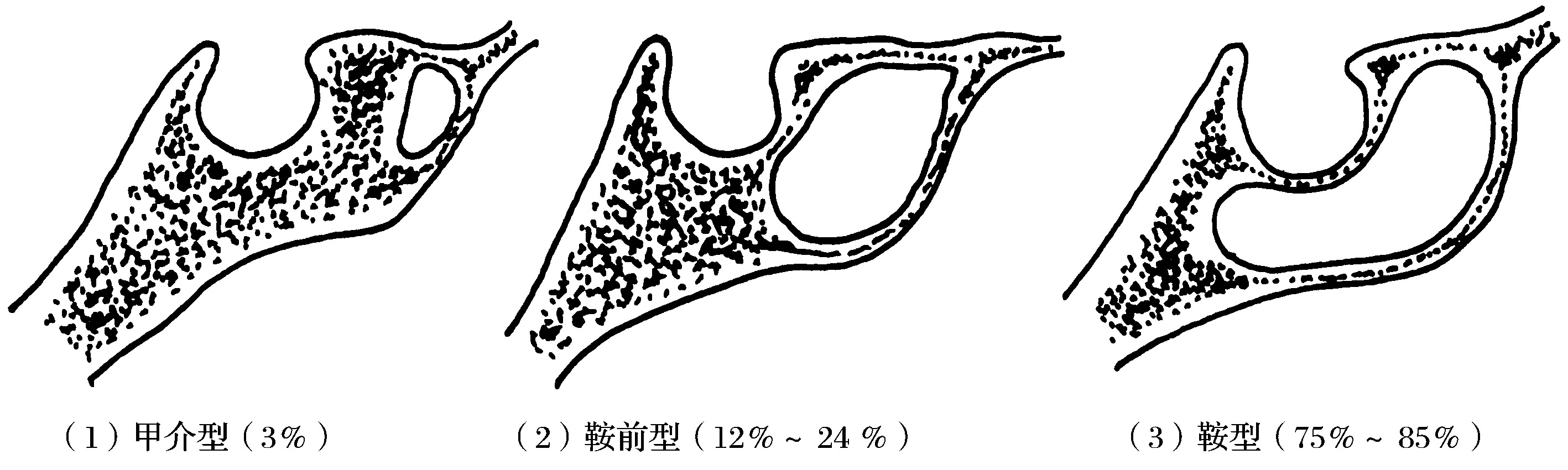 经单侧鼻腔蝶窦入路垂体腺瘤切除术