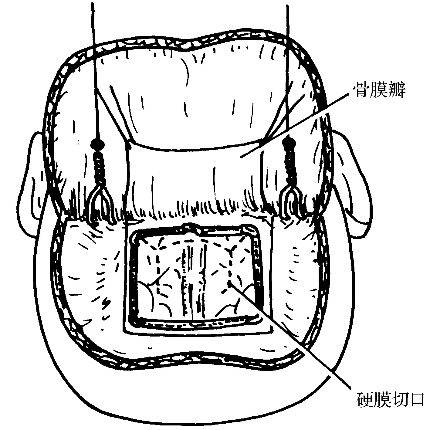 经纵裂入路鞍区肿瘤切除术