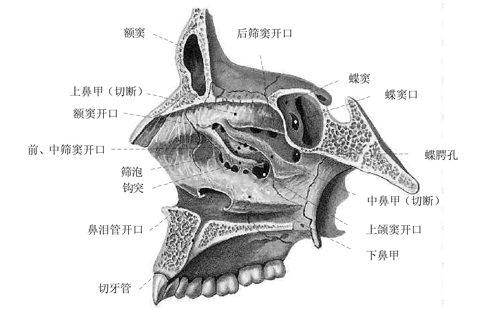 图3—69 气化中鼻甲和偏曲的鼻中隔-眼耳鼻喉-医学