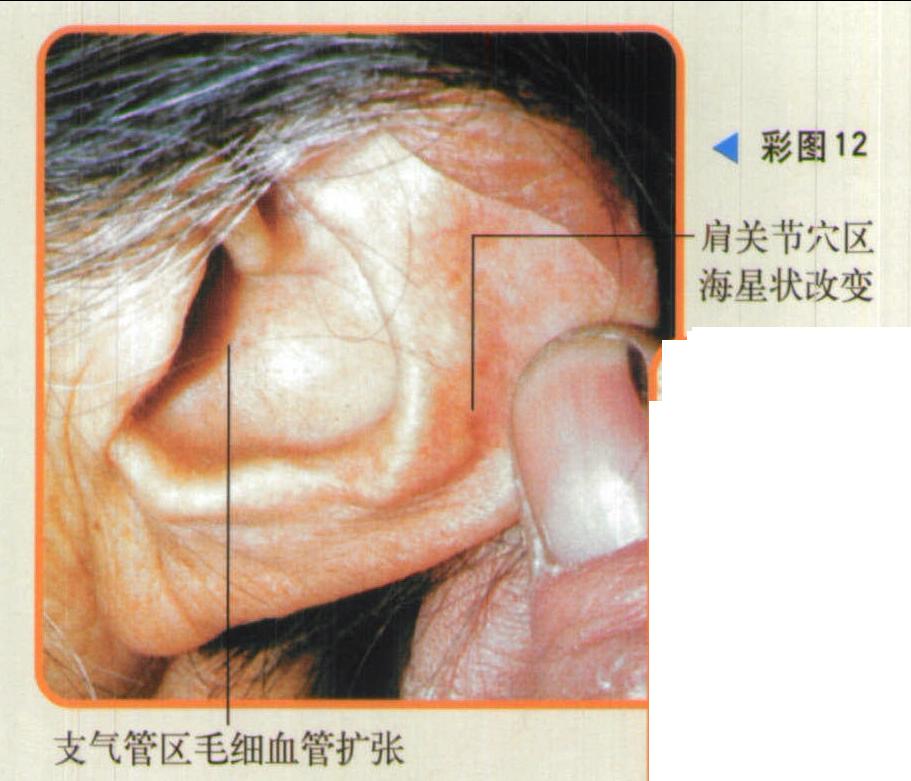第四節(jié) 支氣管擴(kuò)張