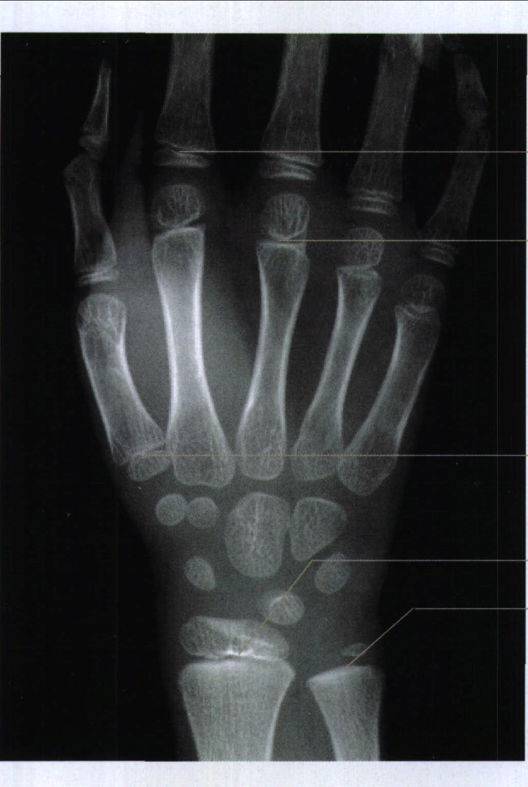 图1-19 手骨骺板的骨化时间