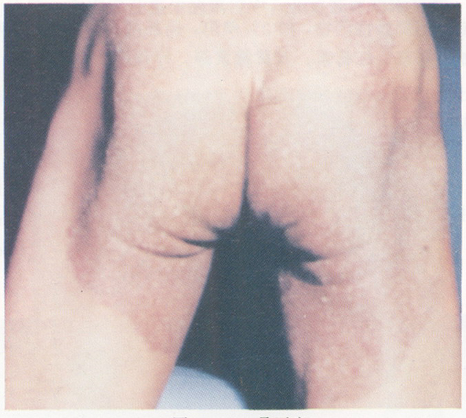 疊瓦癬