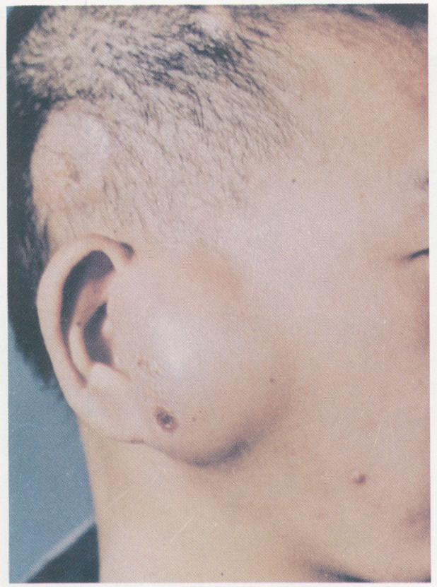 鐵銹色小孢子菌肉芽腫