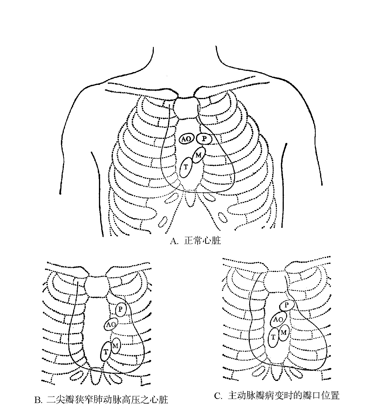 图1-19　心脏瓣口在胸前的投影位置