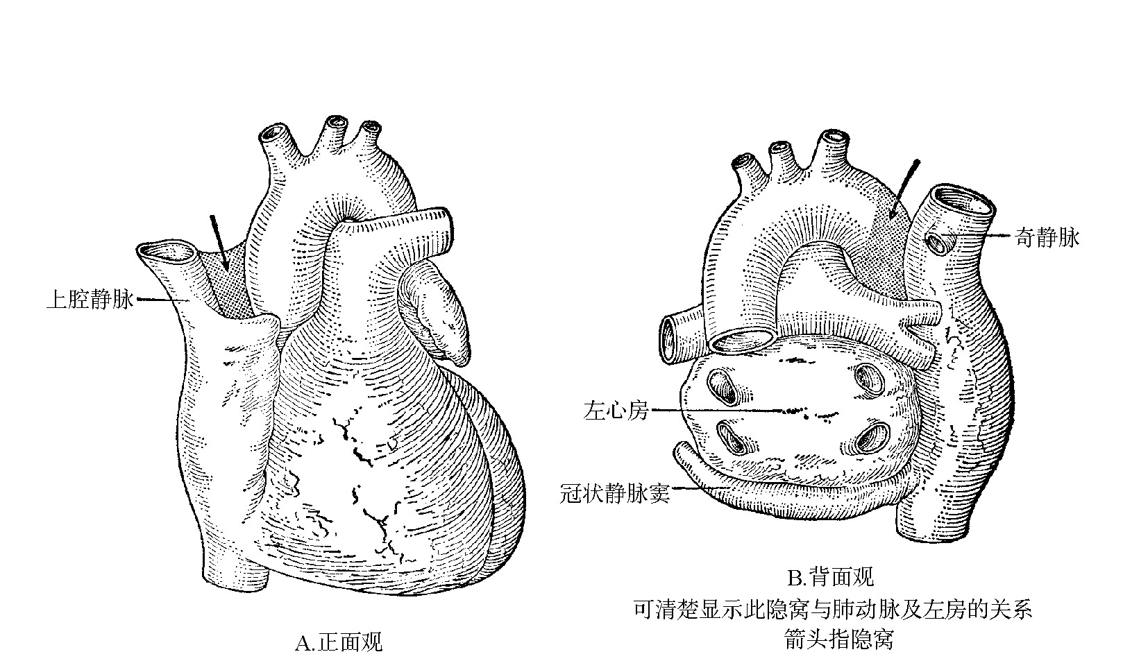 图1-9　心包:主动脉-上腔静脉隐窝