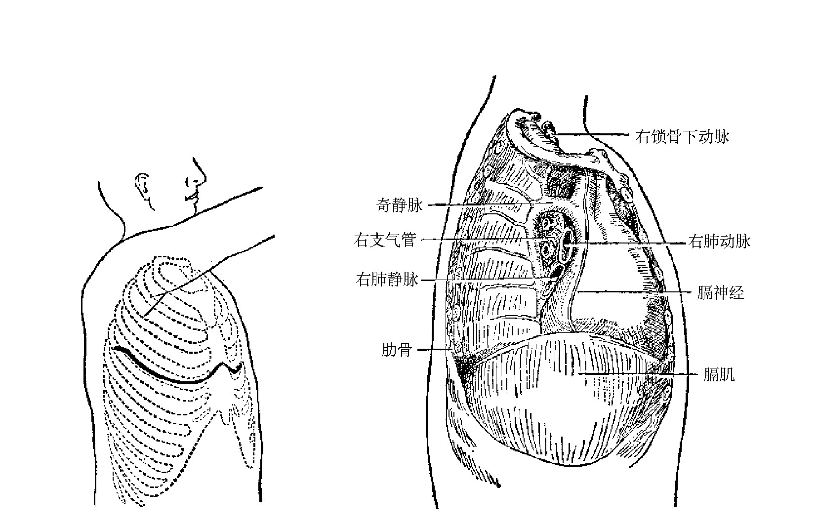 图2-6　右侧开胸