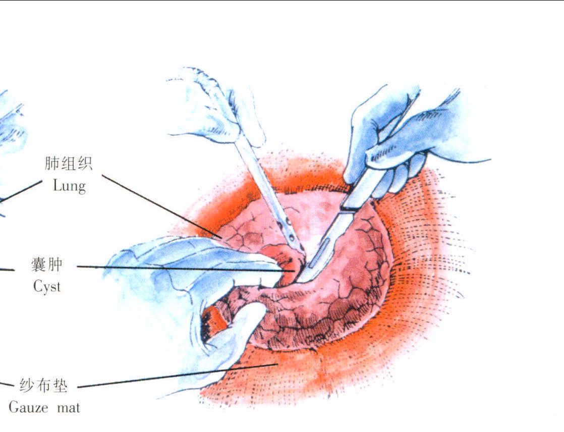 肺包蟲(chóng)囊腫切除術(shù)