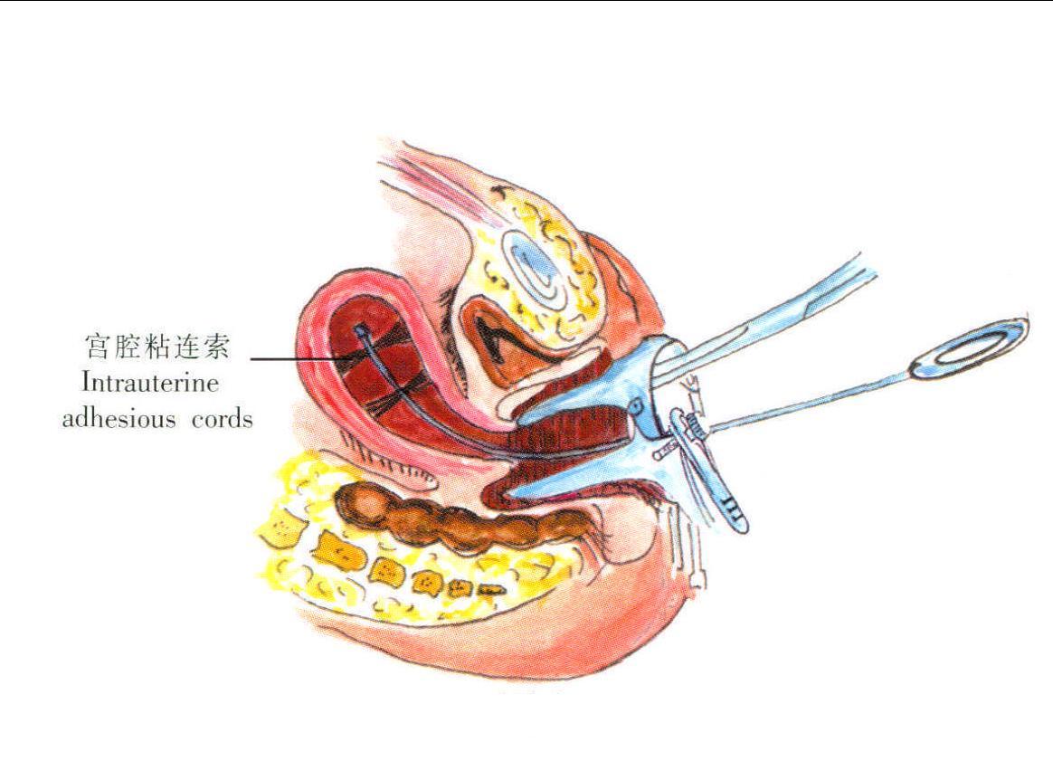 宫腔分离图解图片