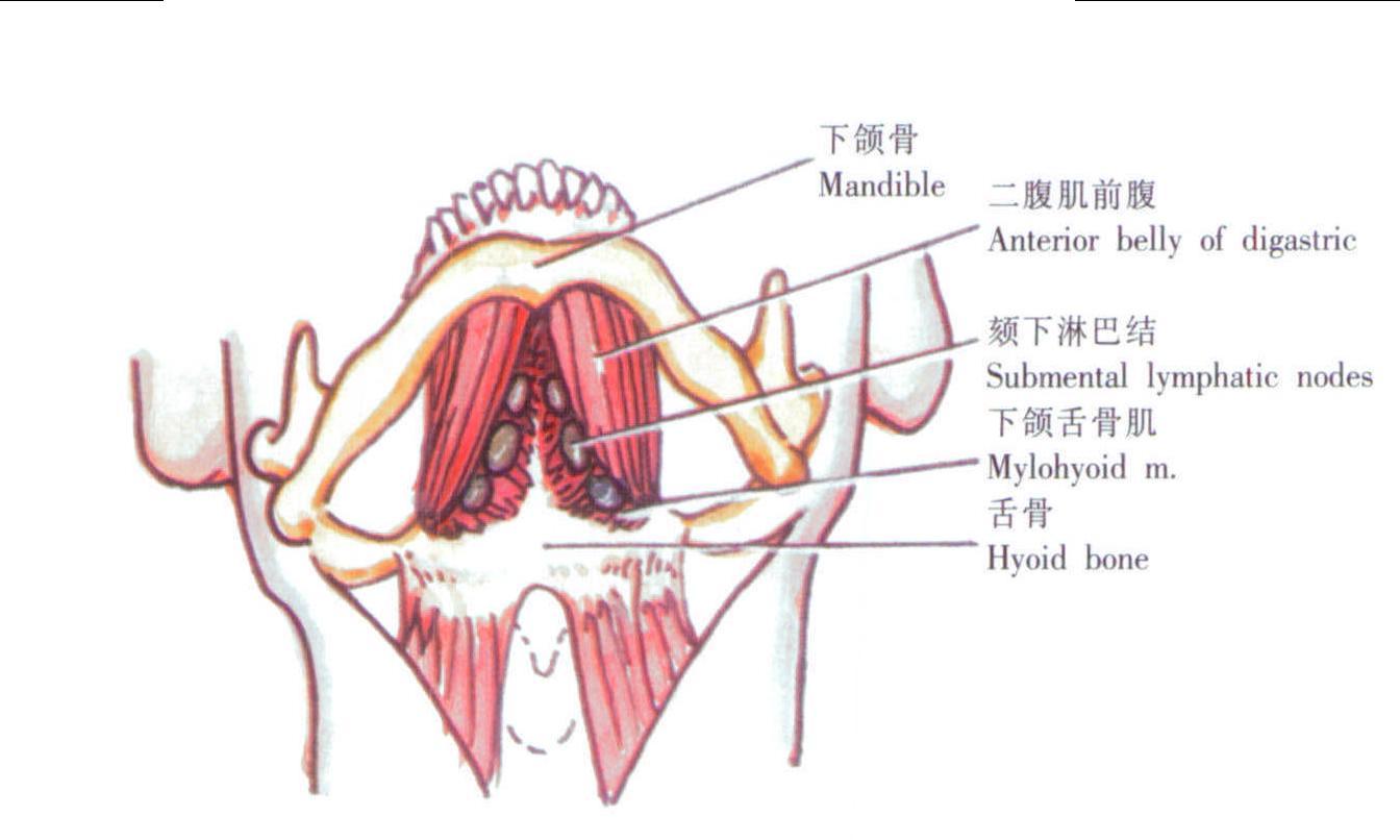 頦下間隙膿腫切開引流術