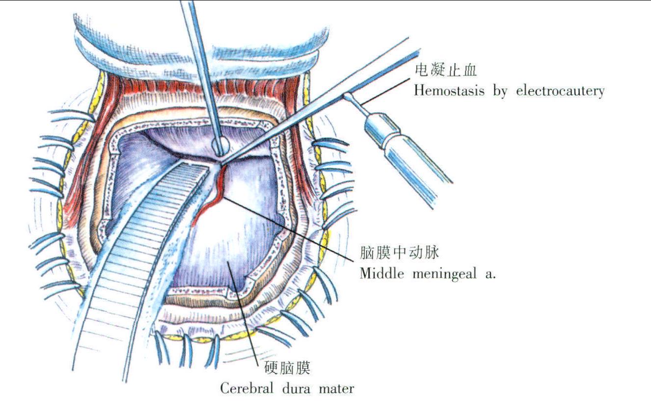 硬腦膜外血腫清除術(shù)