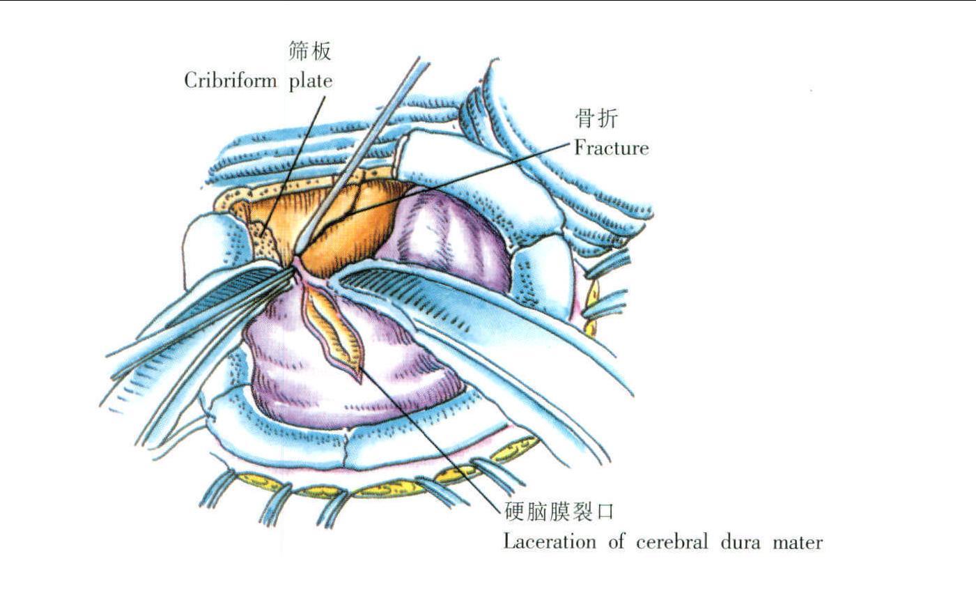 腦脊液鼻漏修補(bǔ)術(shù)