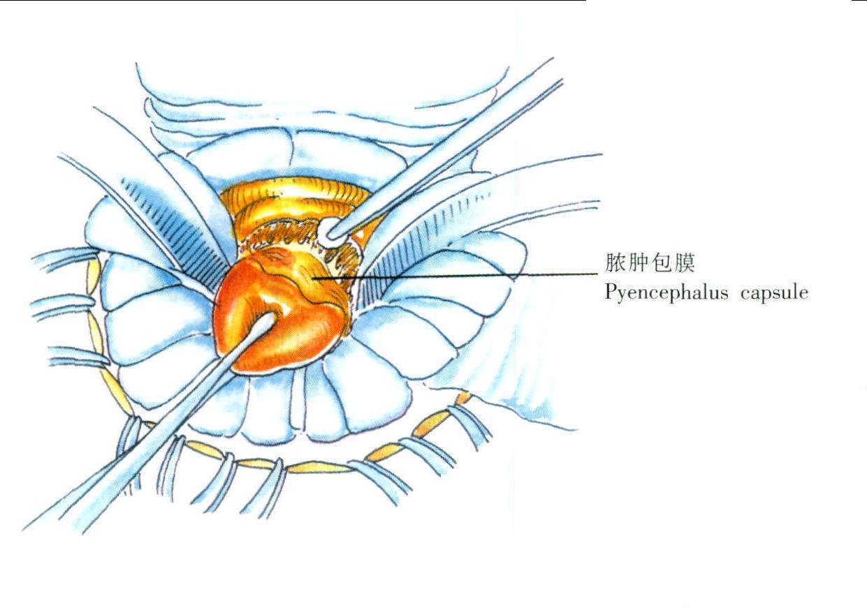 腦膿腫切除術