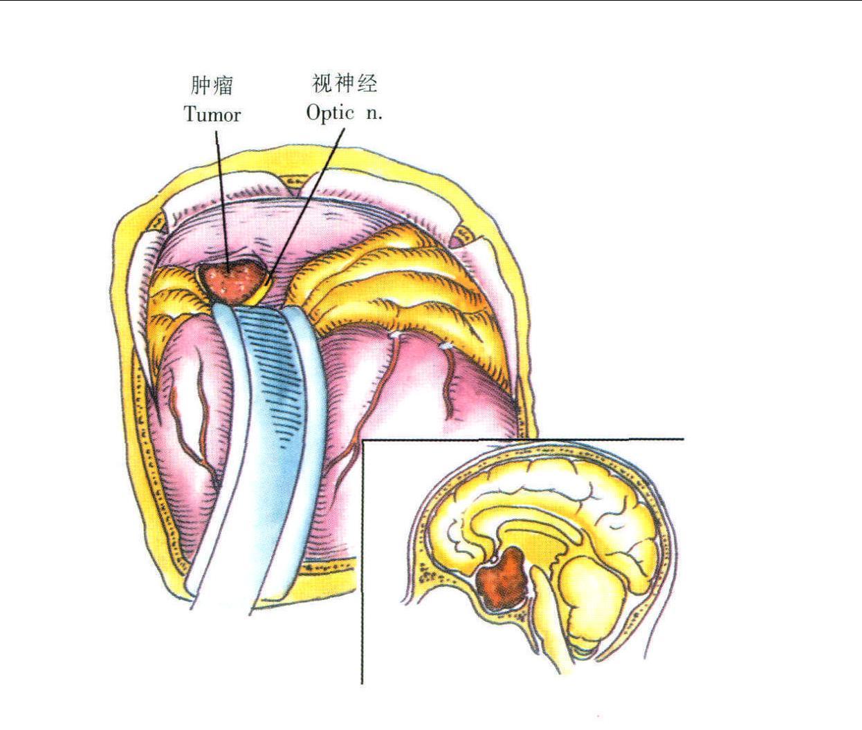 經(jīng)額葉入路垂體腺瘤切除術(shù)