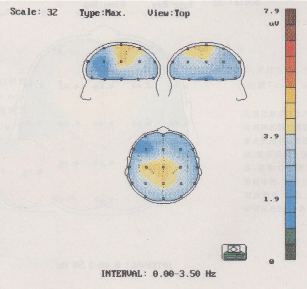 图5-66 震颤麻痹(Paralysis agitans)脑电地形图侧位图