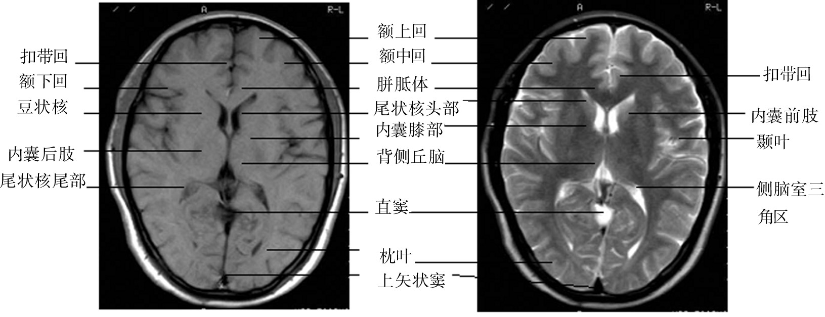 二、颅脑正常MRI解剖