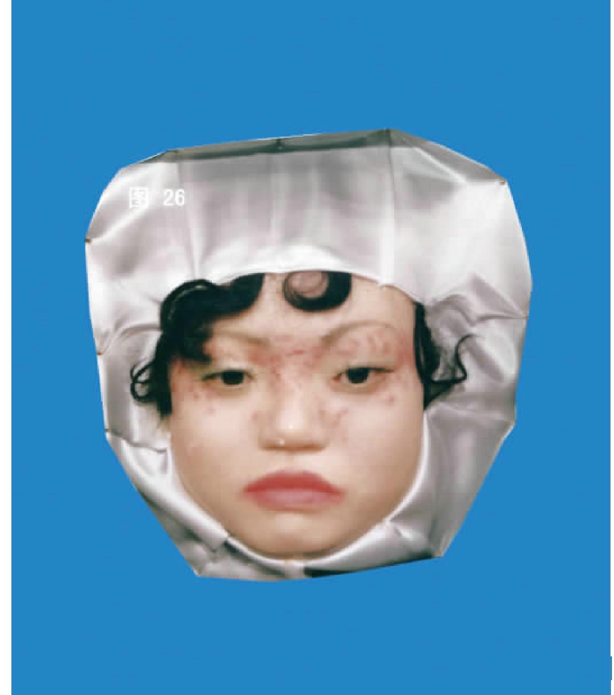 顏面播散性粟粒狼瘡