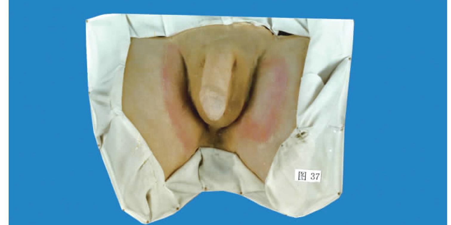 股癬