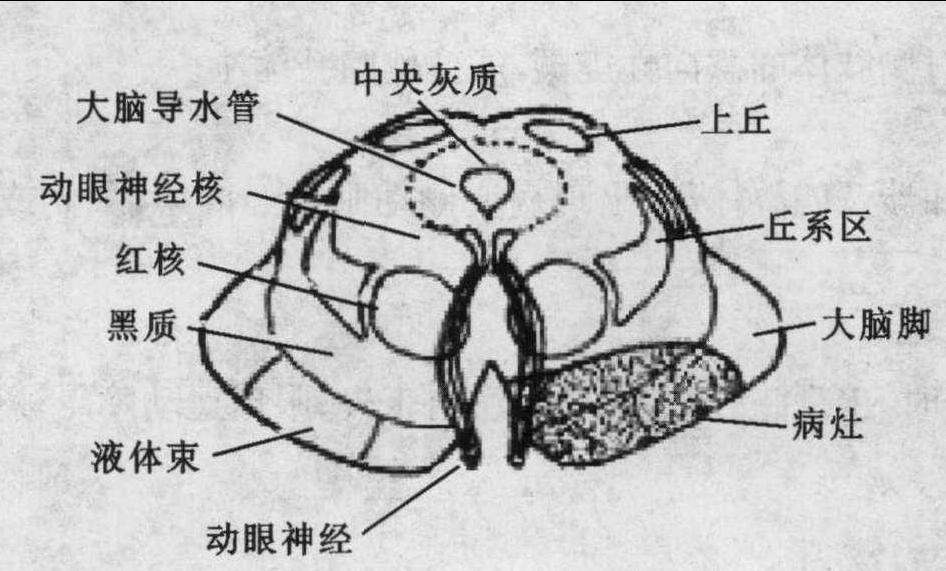 第五節(jié) 腦干病變的解剖生理與定位診斷