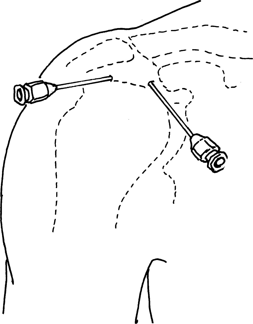 第六節(jié) 關(guān)節(jié) 腔穿刺