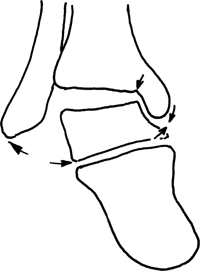 五、踝關(guān)節(jié)骨折脫位