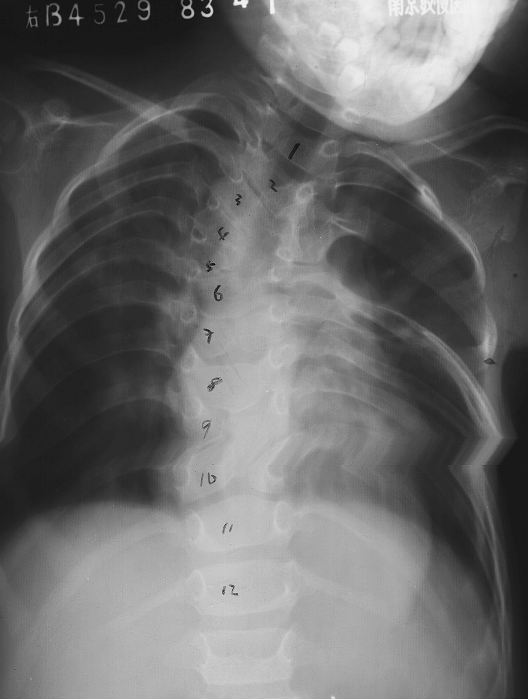 病例4 脊柱复杂畸形