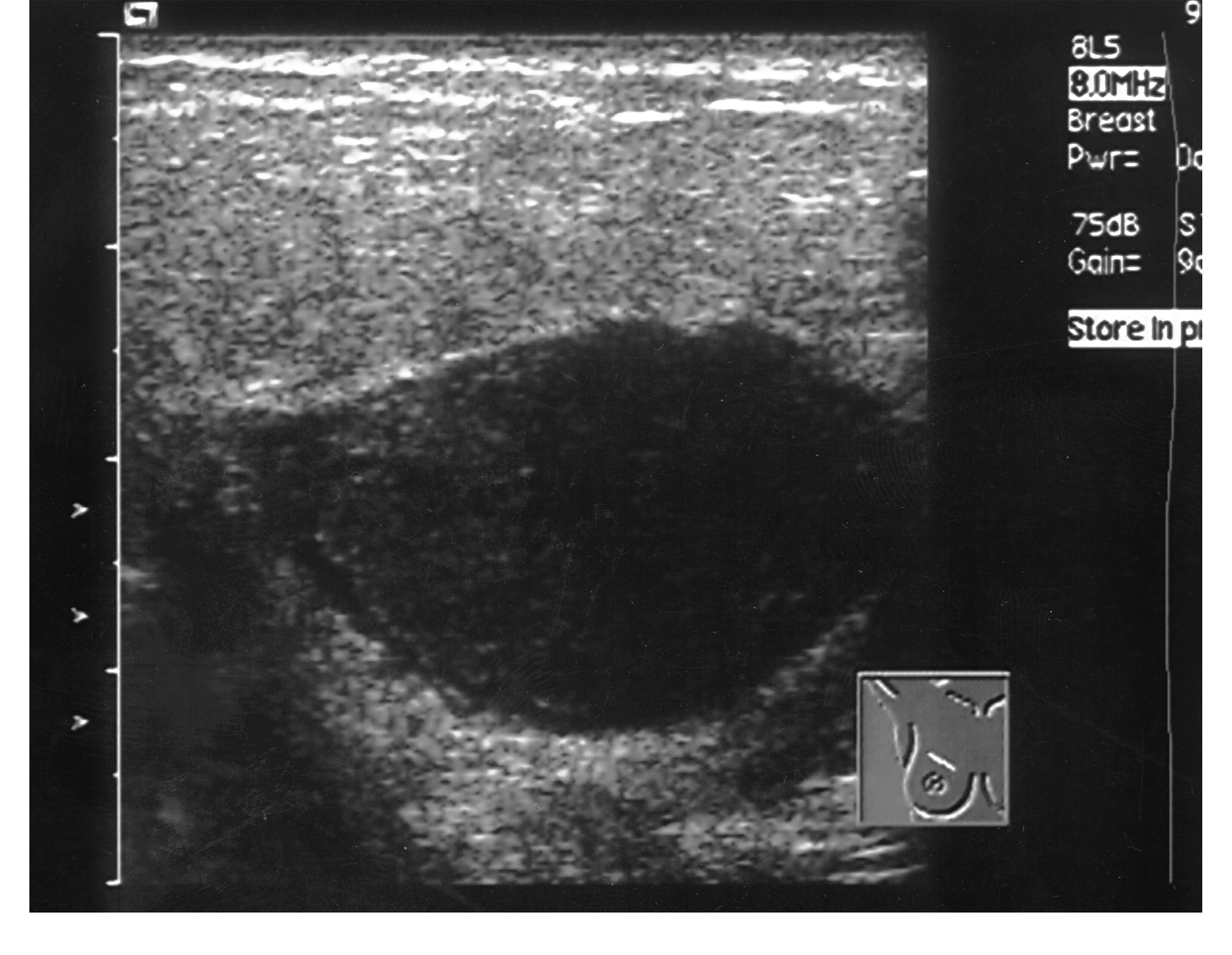 病例2-24　乳腺膿腫