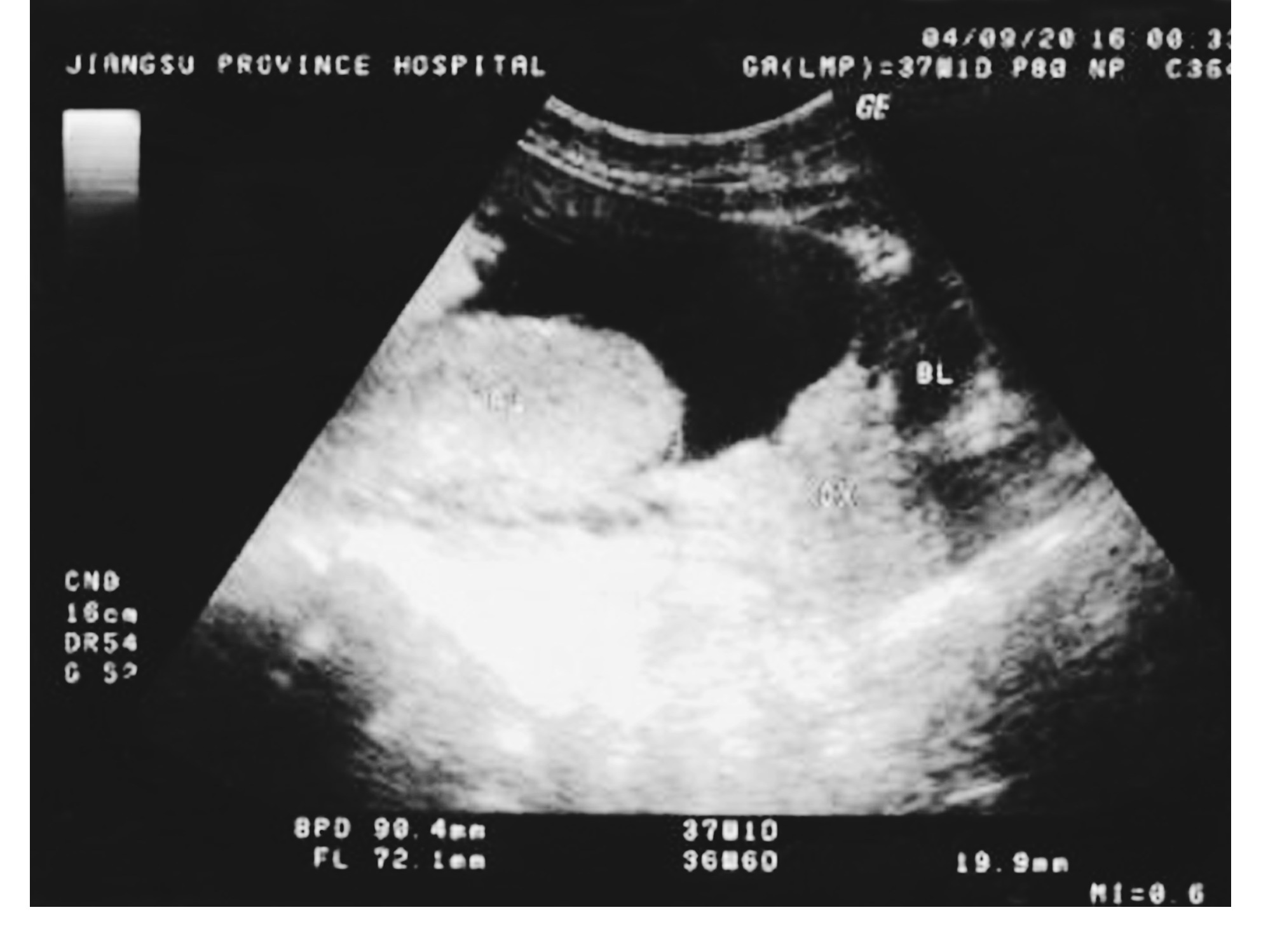 图4-37人工胎盘剥离术-妇产科学-医学
