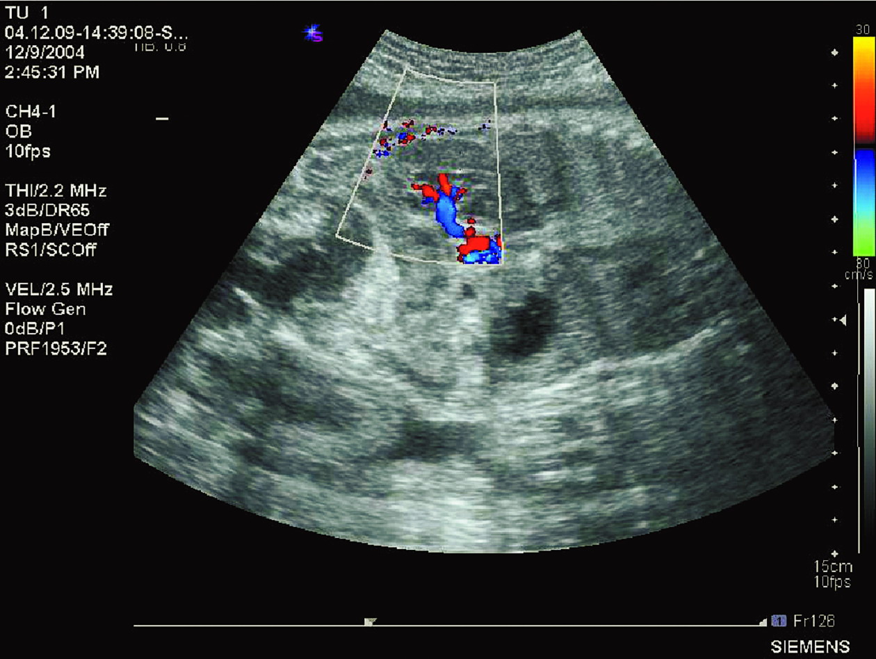 图7-ⅹⅹⅲ　胎儿肾脏血流及频谱