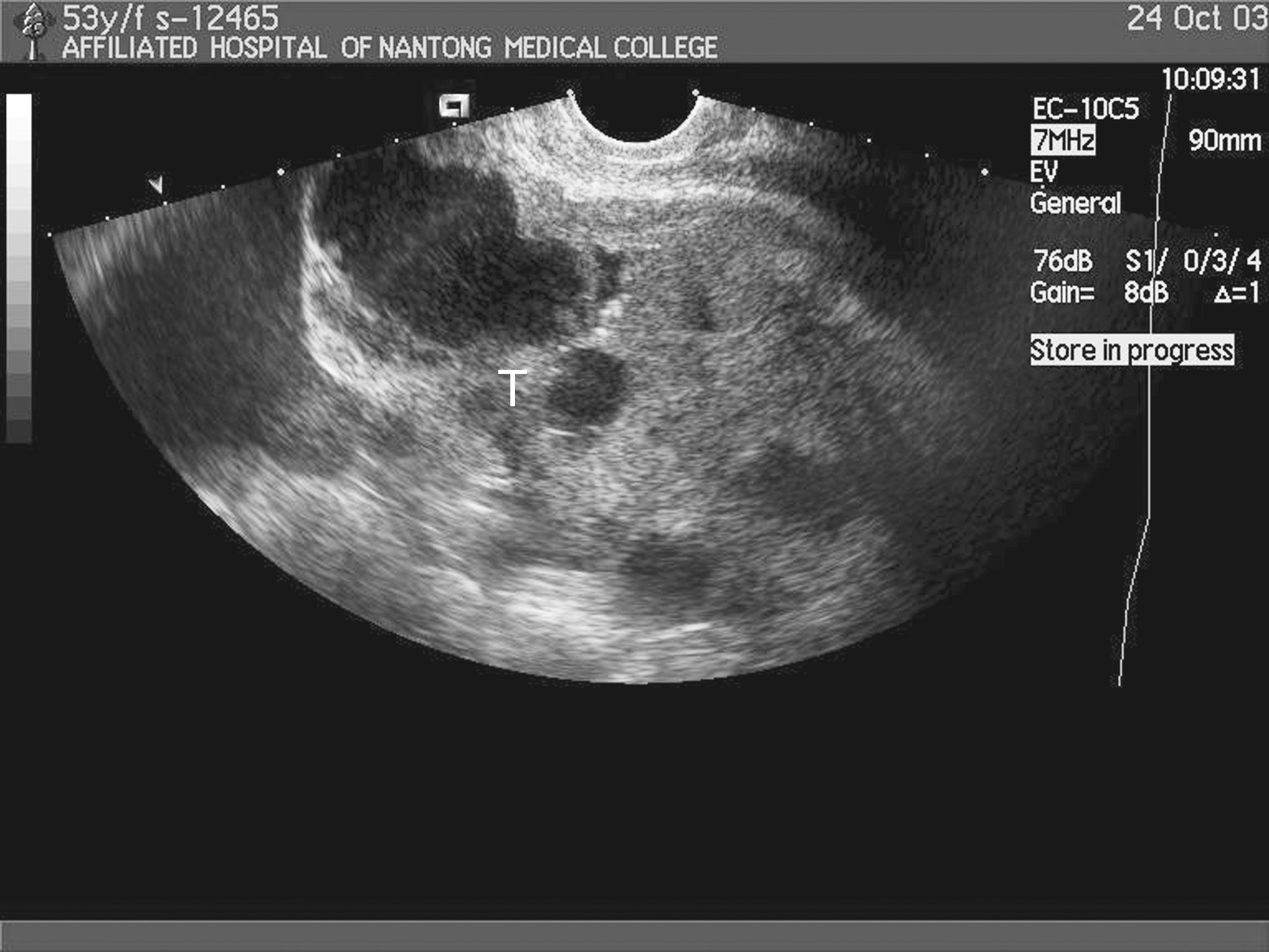 囊腺瘤超声图片