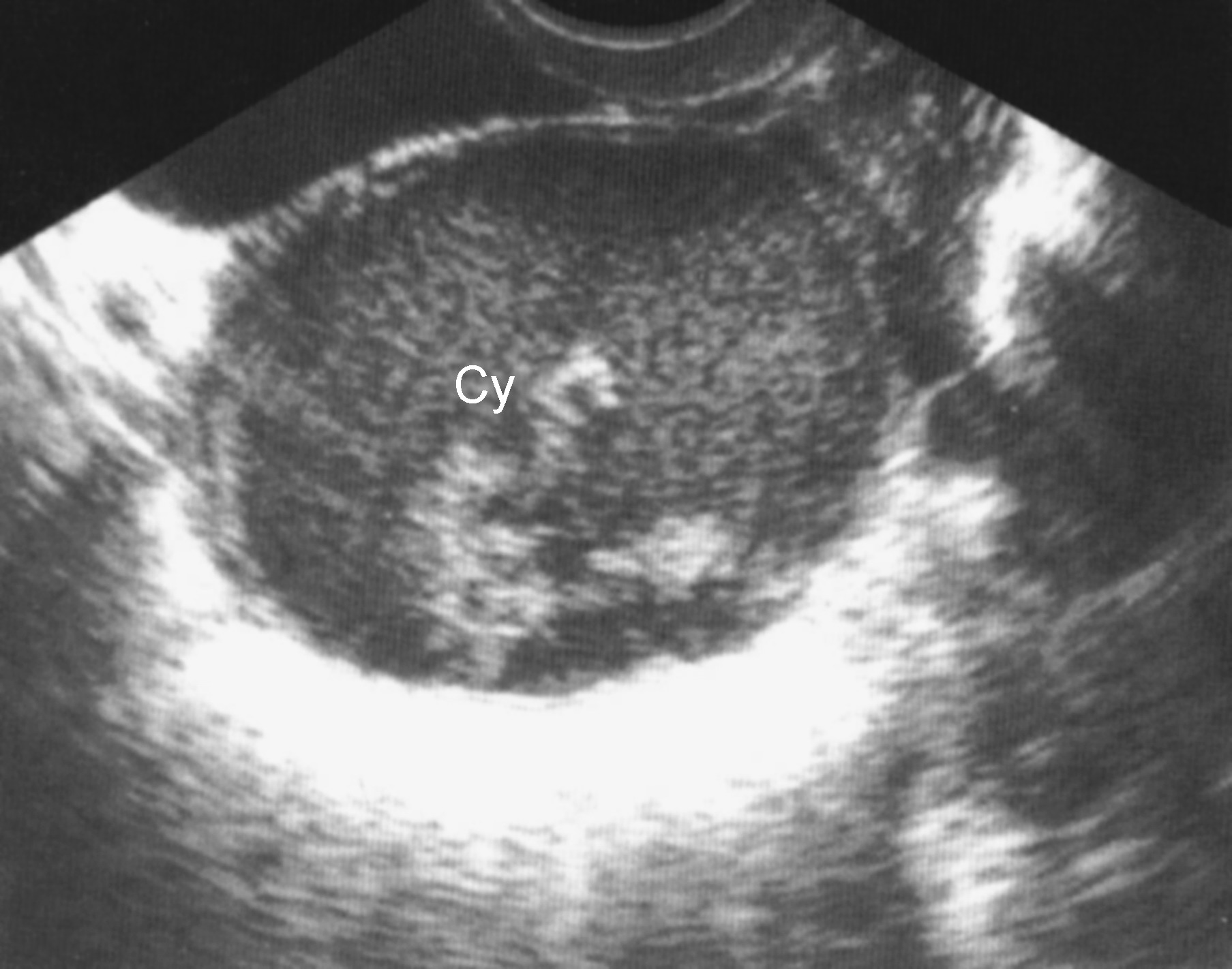 四、卵巢子宫内膜异位囊肿(混合型)