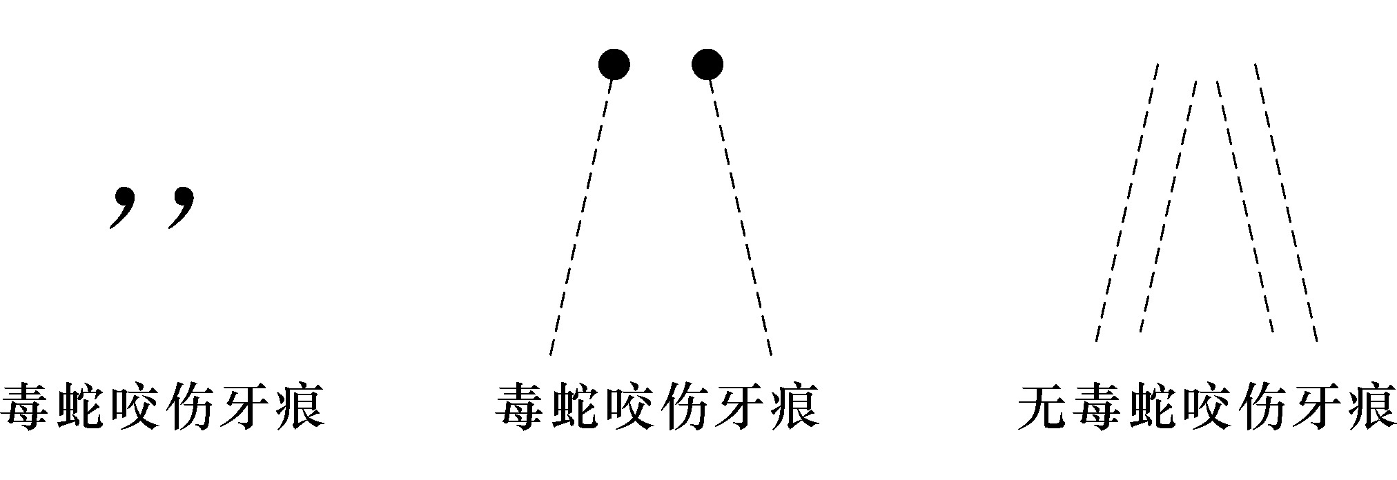 毒蛇咬傷