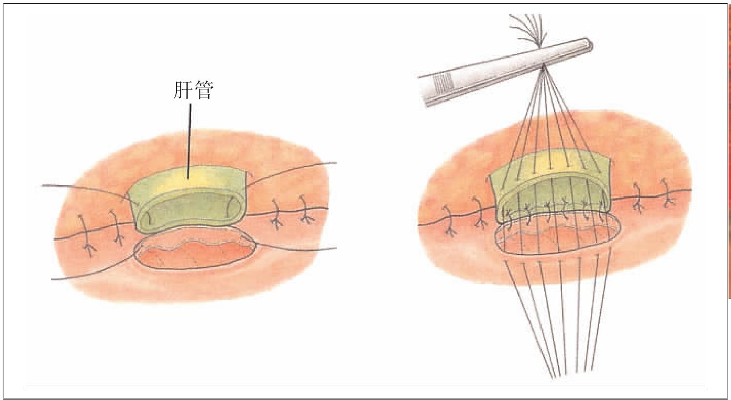 胆肠吻合器吻合术图解图片
