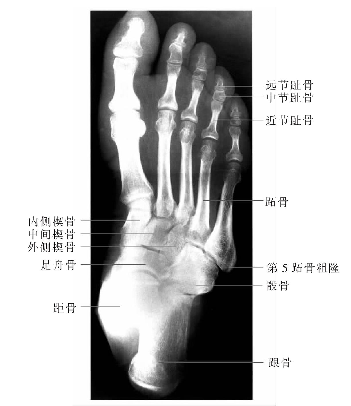 圖48 足骨X線像（上面觀）