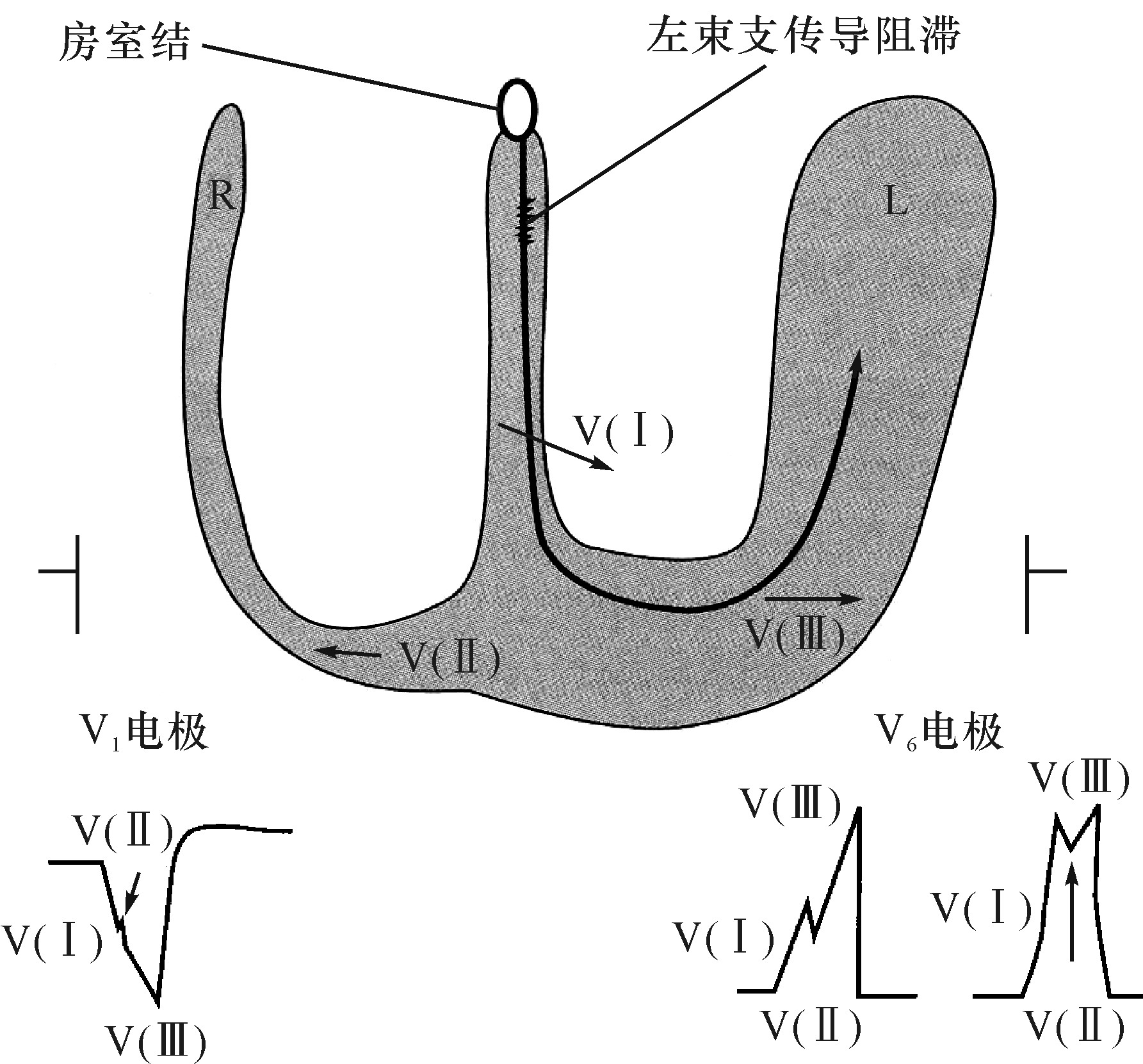 左束支傳導阻滯
